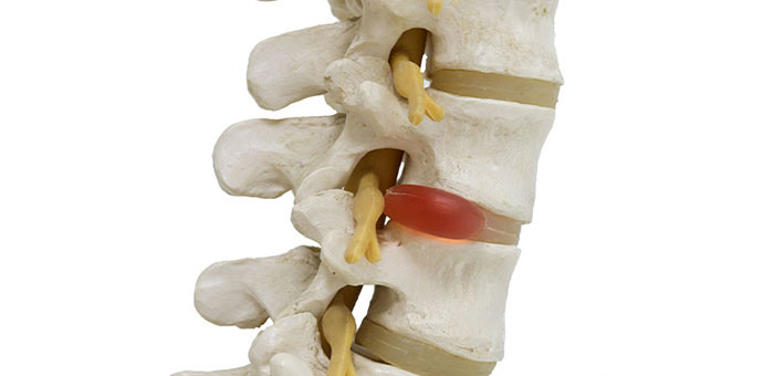 Herniated disc in spine before visiting Minnetonka chiropractor