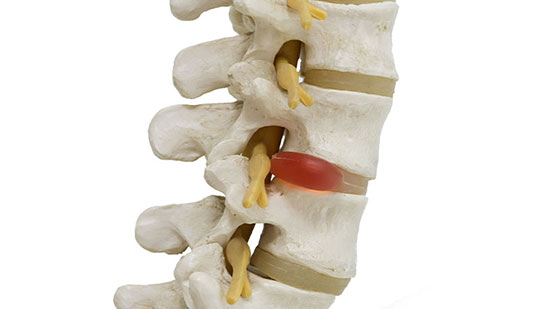 Herniated disc in spine before visiting Minnetonka chiropractor