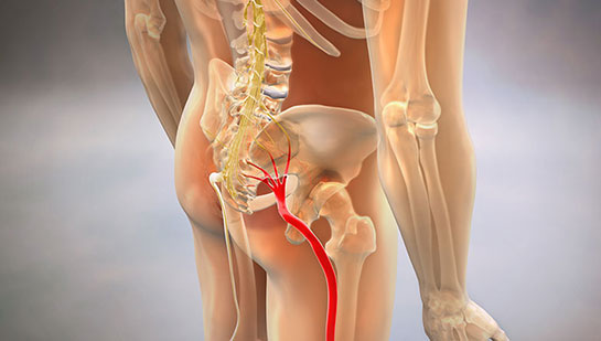 Sciatic nerve pain before chiropractic treatment from Minnetonka chiropractor