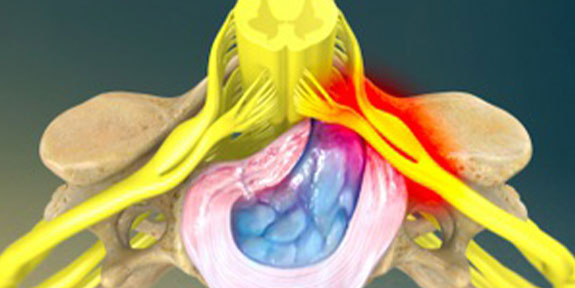 Herniated Disc Minnetonka